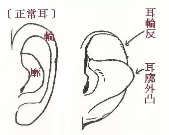 反廓耳